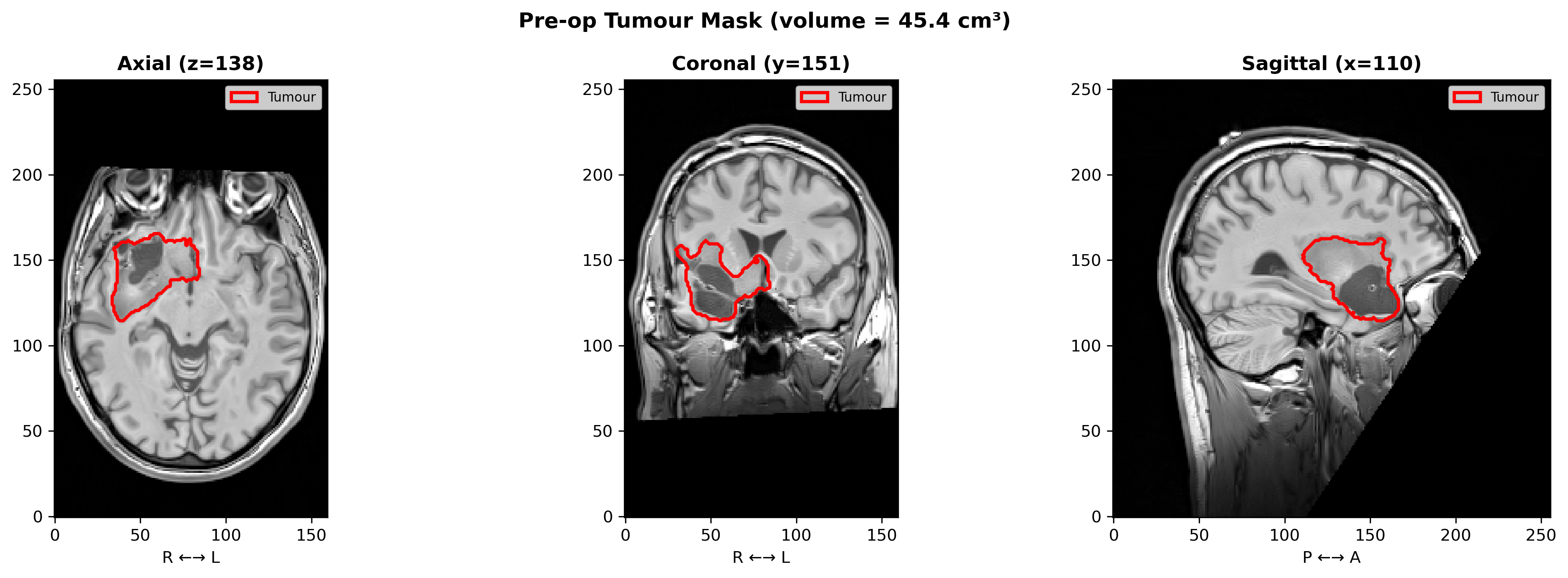 Pre-operative T1-weighted MRI with tumour outline