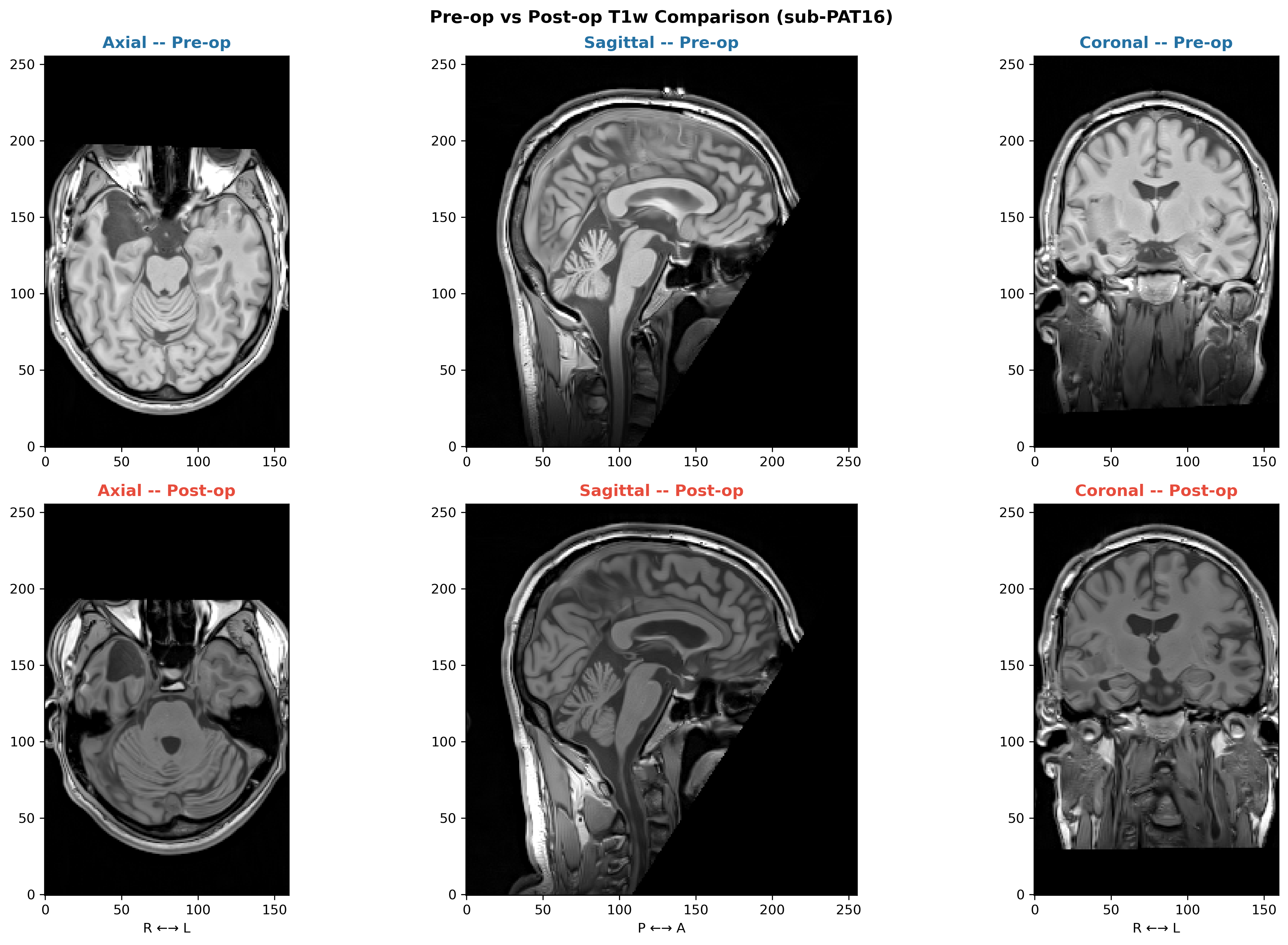 Pre- and post-operative T1-weighted MRI in three planes