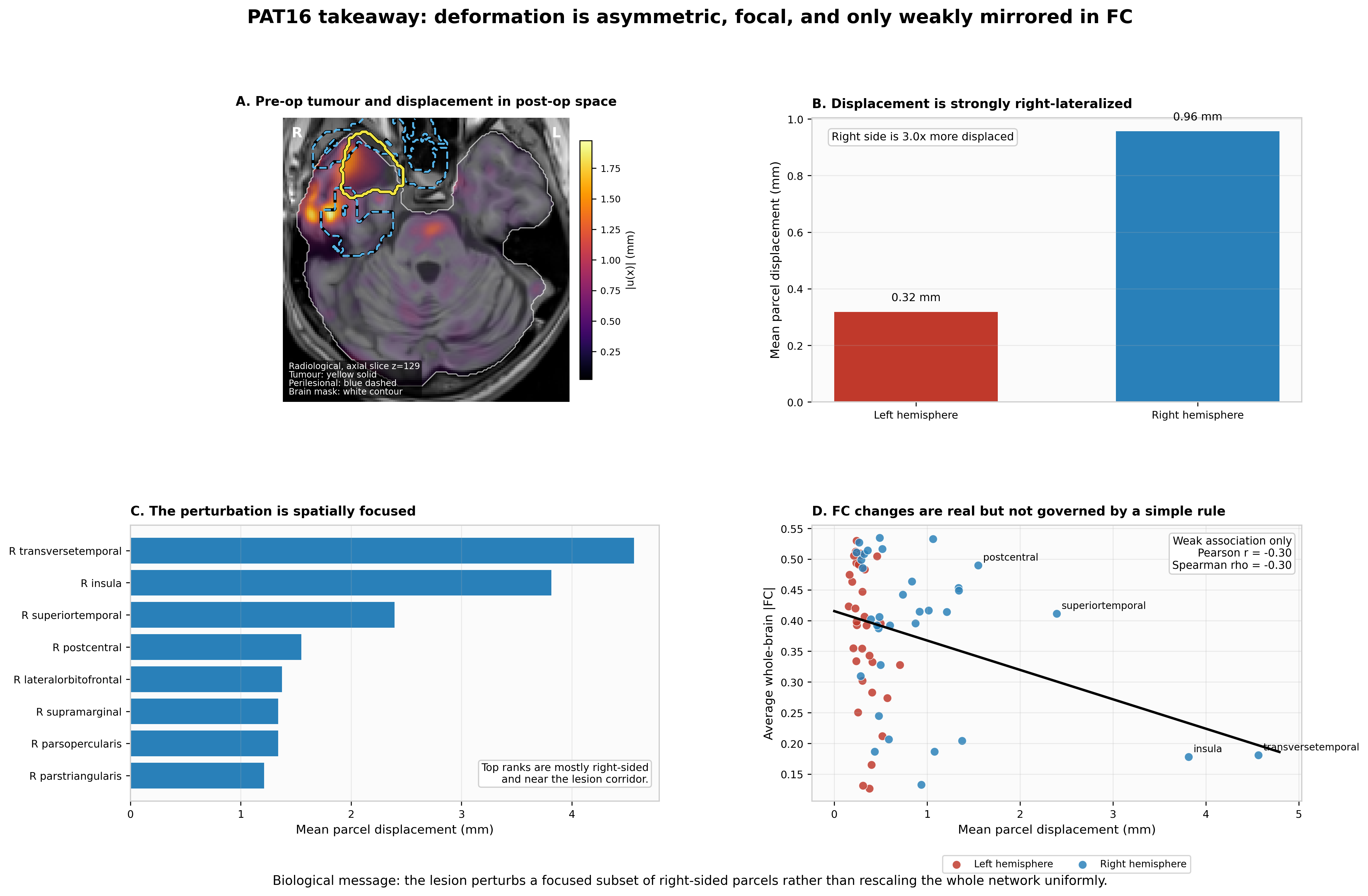 Deformation is right-lateralised and focal